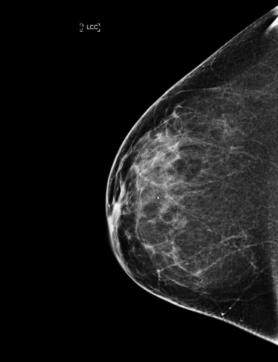 How Machine Learning Is Transforming Breast Cancer Risk Prediction ...